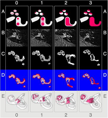 Intravenous Delayed Gadolinium-Enhanced MR Imaging of the Endolymphatic Space: A Methodological Comparative Study